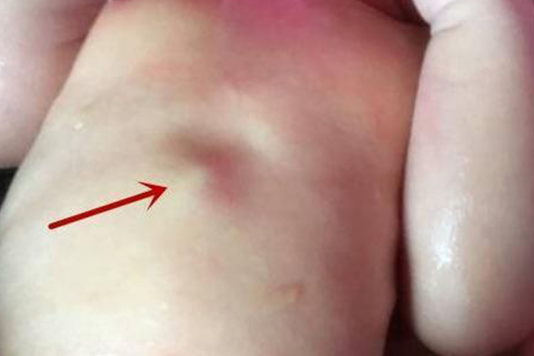 维生素D缺乏性佝偻病畸形图