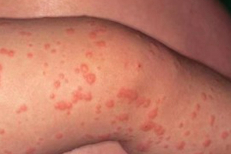 小儿丘疹性肢端皮炎大红疙瘩图 小儿丘疹性肢端皮炎大红疙瘩图