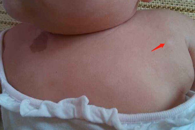 婴儿胸前白色糠疹图