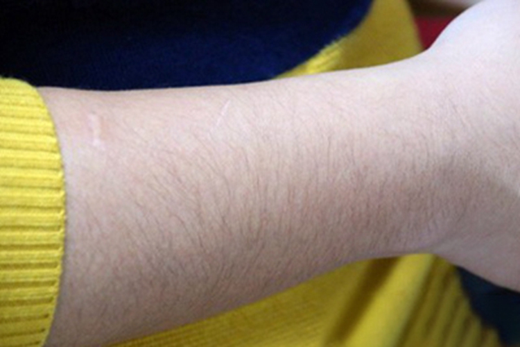 多囊卵巢综合征胳膊多毛图