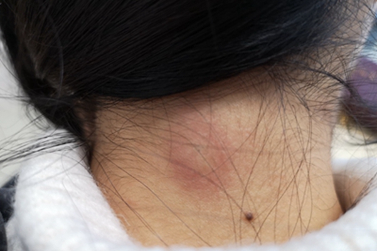 皮样囊肿肿块图