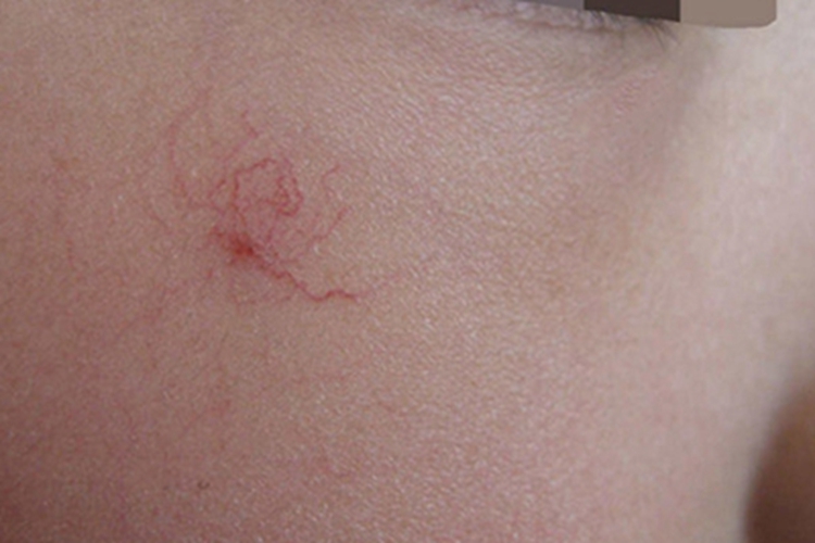 蜘蛛状毛细血管扩张症面部红点图