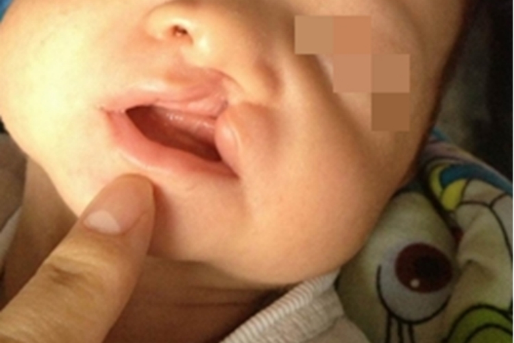 先天性风疹综合征嘴唇有裂口图