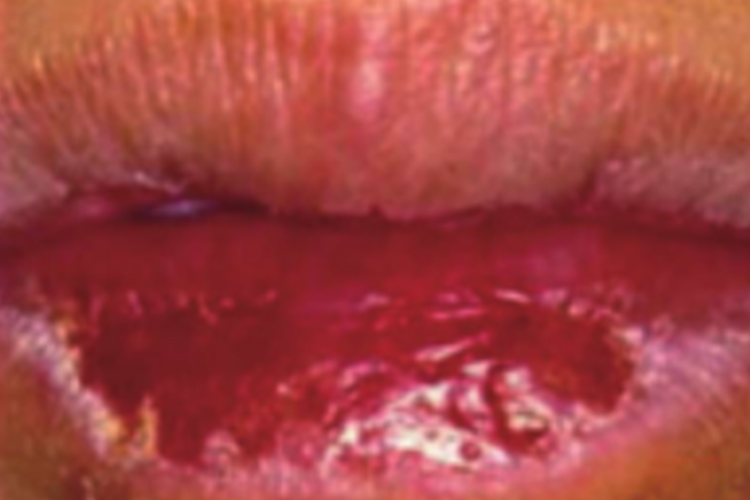 慢性唇炎唇部糜烂图片