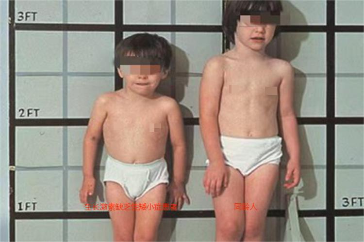 生长激素缺乏性矮小症症状图 生长激素缺乏性矮小症症状图