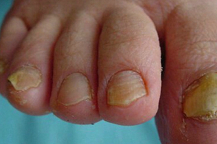 慢性黏膜皮肤念珠菌病趾甲增厚图