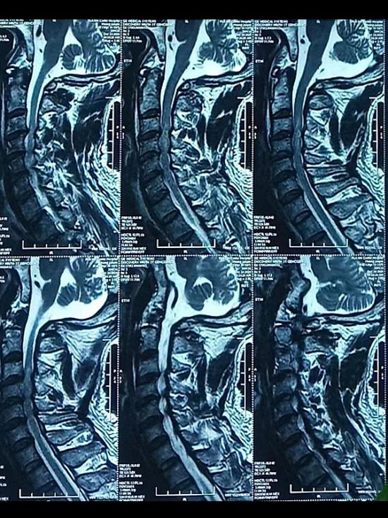 颈脊髓损伤1.png