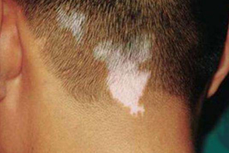 散发型白癜风后脑勺白斑图