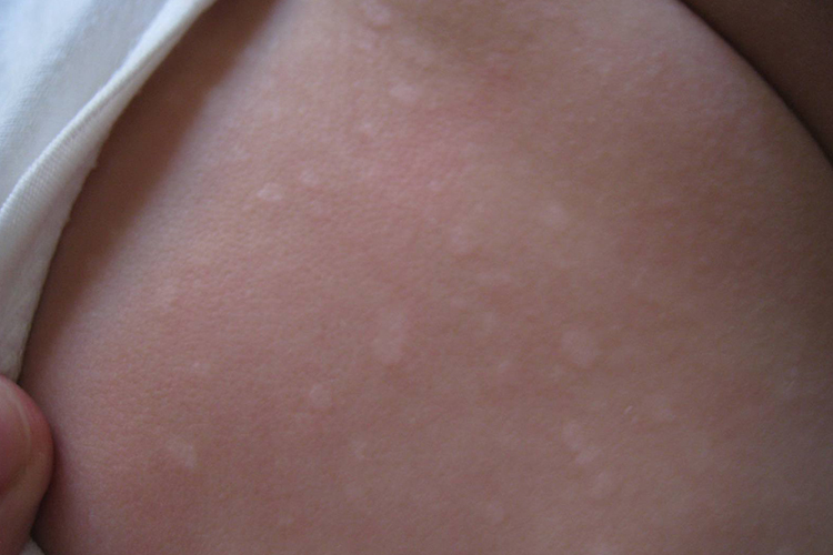 婴儿胸前花斑癣图