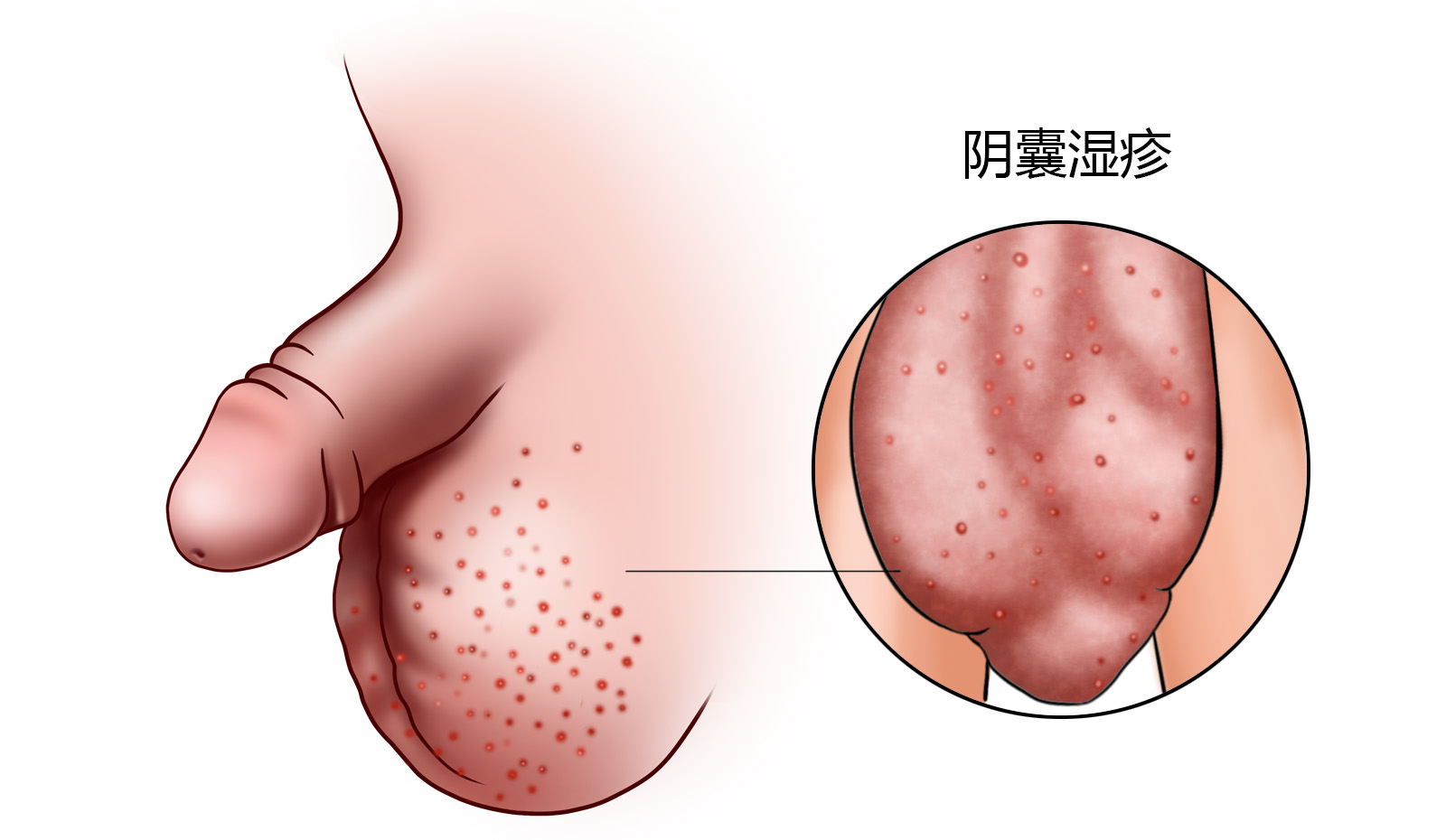 正常阴囊皮图片图片