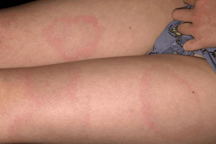 莱姆病一期红斑图