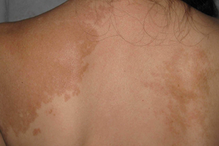 泛发型表皮痣肩部症状图 泛发型表皮痣肩部症状图