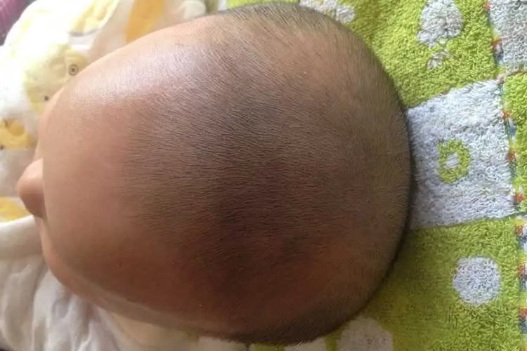 正常宝宝冠状缝图