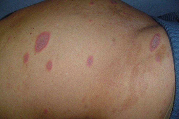 扁平苔藓脱屑图