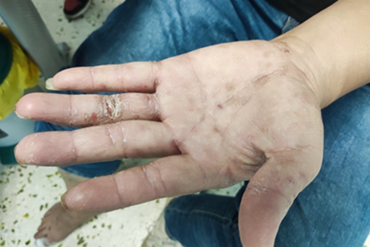慢性湿疹手指症状图