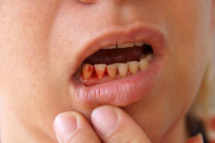 牙龈息肉早期出血图