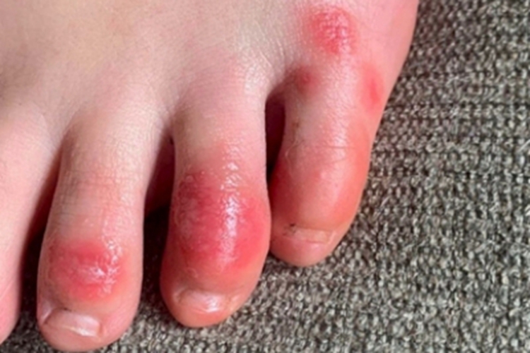 脚趾长水疱脚趾红肿图 脚趾长水疱脚趾红肿图