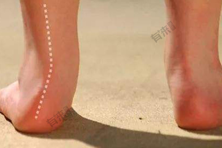 足跟着地时外踝穴部凹陷图 足跟着地时外踝穴部凹陷图