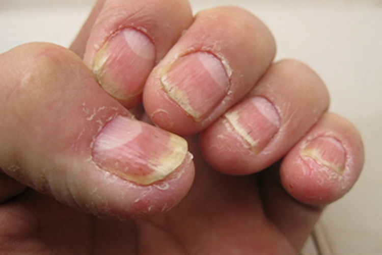 银屑病甲指甲凹凸不平图