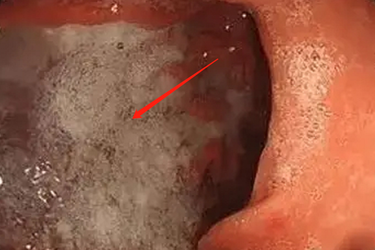 胃癌胃镜下显示黏膜发白图