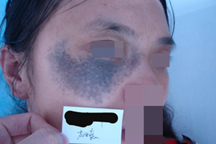 色素型胎记眼周黑斑图
