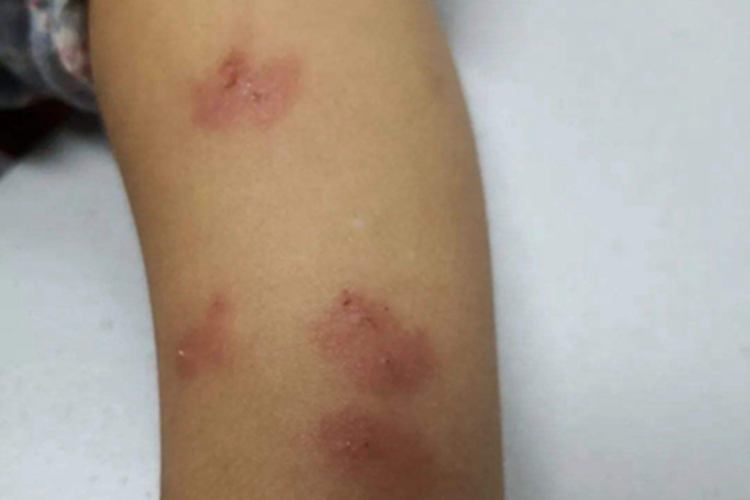 蚋叮咬引起的皮肤反应渗液图 蚋叮咬引起的皮肤反应渗液图