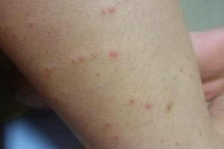 瘰疬性苔藓红点图