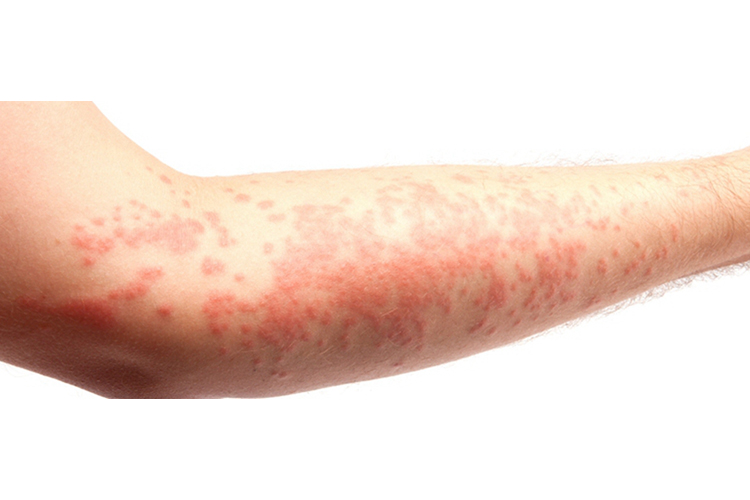 艾滋病手臂红点图
