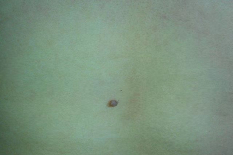 交界痣背部症状图 交界痣背部症状图