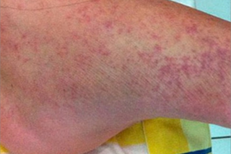 登革热紫斑图 登革热紫斑图