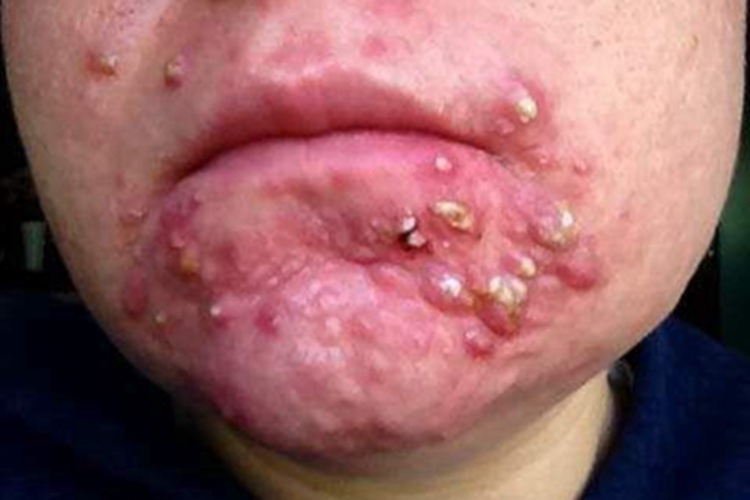 聚合性痤疮皮肤增厚图