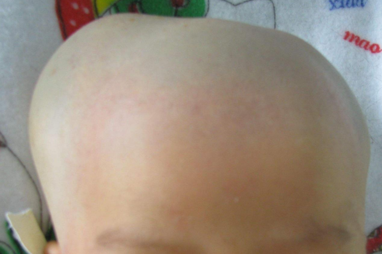 新生儿头颅血肿图