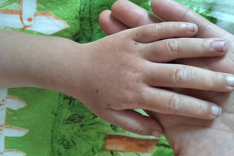 孩子手上雀斑图