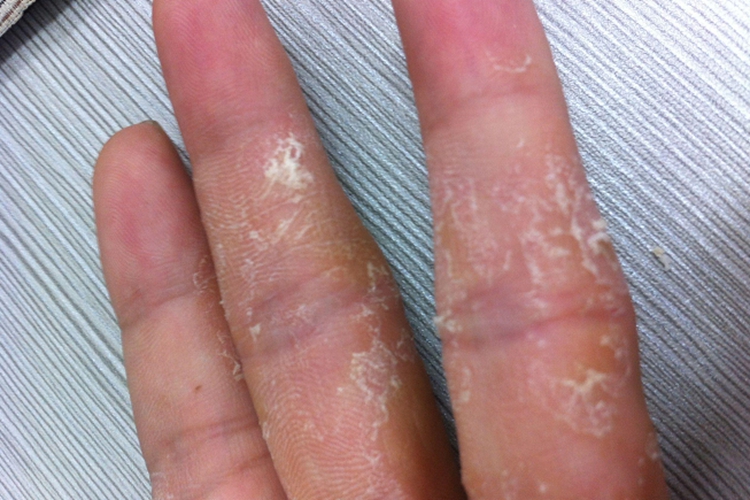 鳞屑角化型手癣手指脱皮图