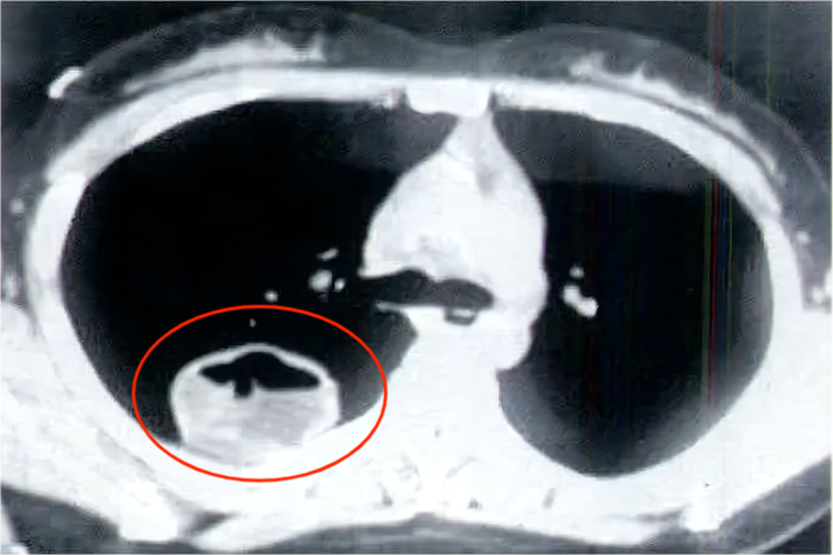 肺囊型棘球蚴病CT图