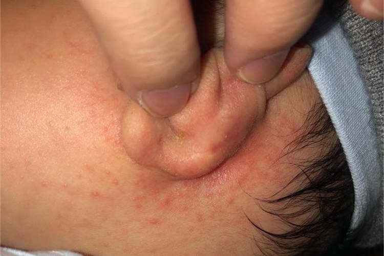 麻疹耳后症状图 麻疹耳后症状图