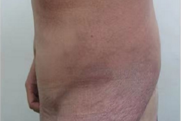 红斑性皮肤松弛症臀部皮肤萎缩图