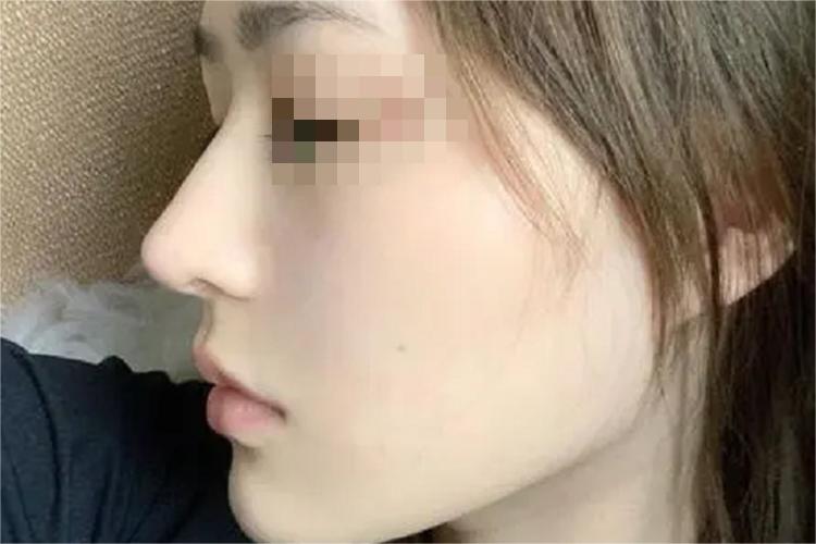 肋骨隆鼻后恢复图 肋骨隆鼻后恢复图