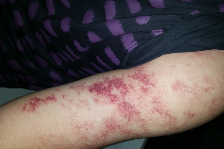 弥漫性躯体性血管角化瘤图