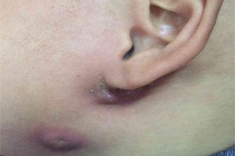 鳃裂瘘管颈部肿块图