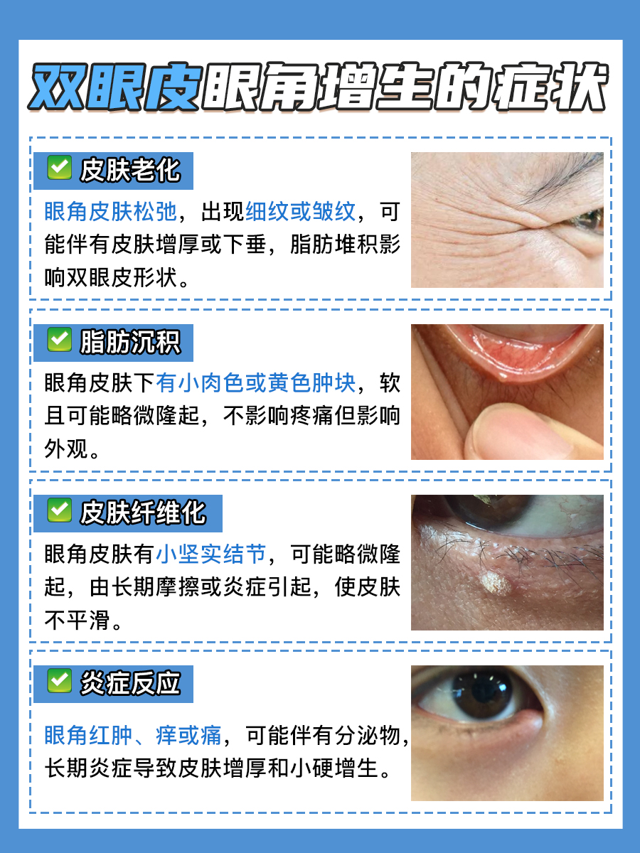 双眼皮眼角增生图片