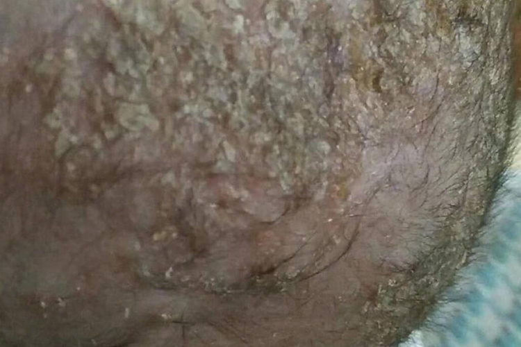 儿童头皮湿疹图