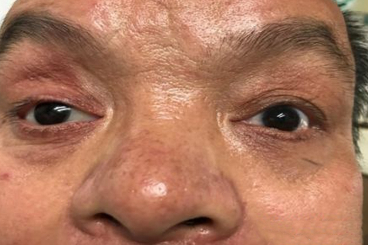 眼球破裂安装义眼恢复后图