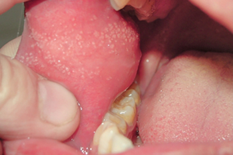 皮脂腺异位症症状图