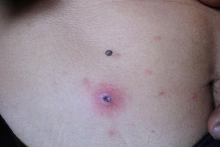 恙虫病焦痂图 恙虫病焦痂图