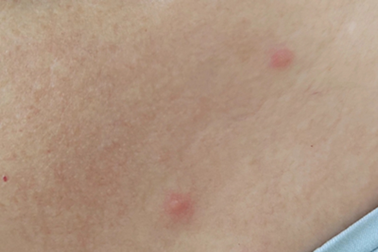 丘疹性荨麻疹颈部红点图