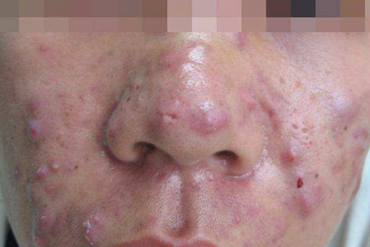痤疮鼻子两侧长小痘痘图