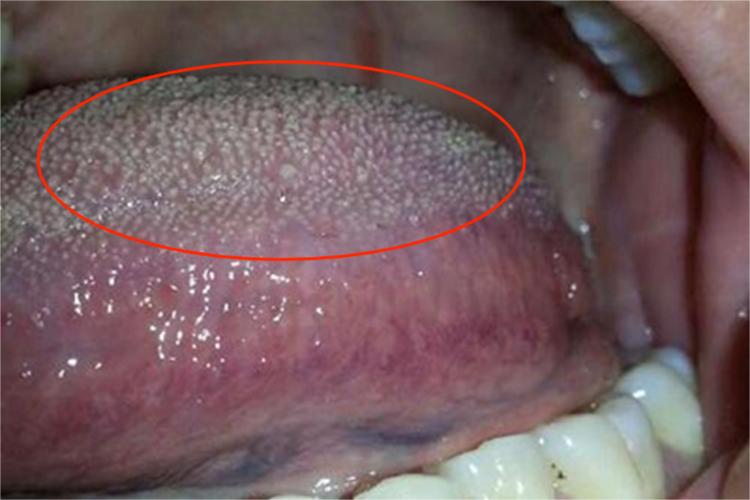口腔白斑病舌侧白斑图