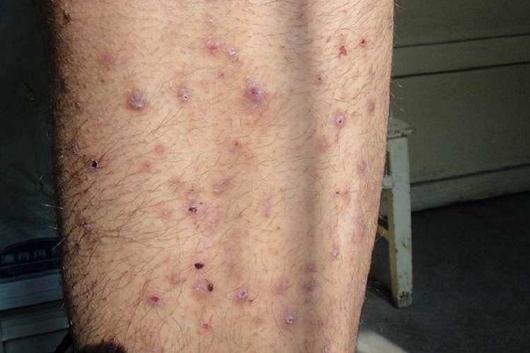 疥疮小腿疙瘩图