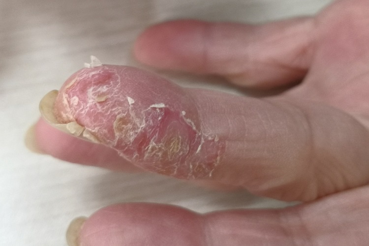 接触性皮炎手指头脱皮图
